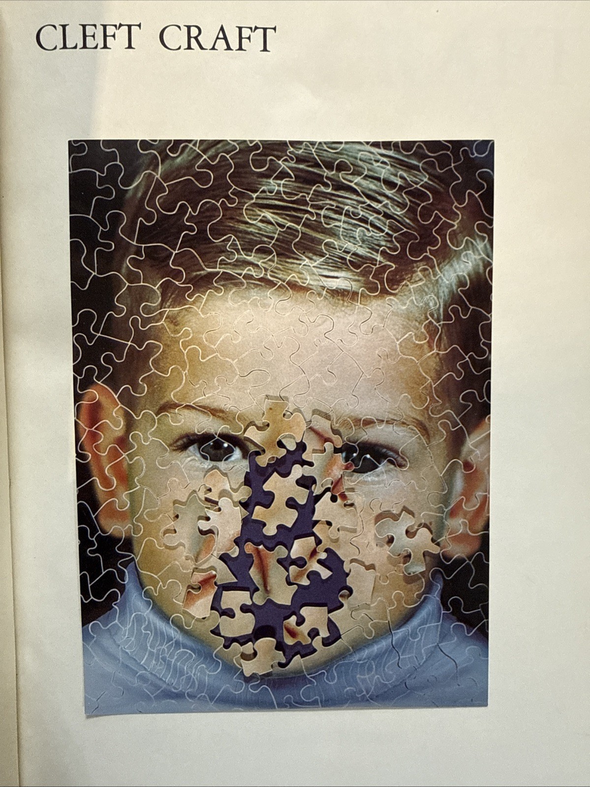 Cleft Craft LEATHER SET :The Evolution of Its Surgery: The Unilateral Deformity