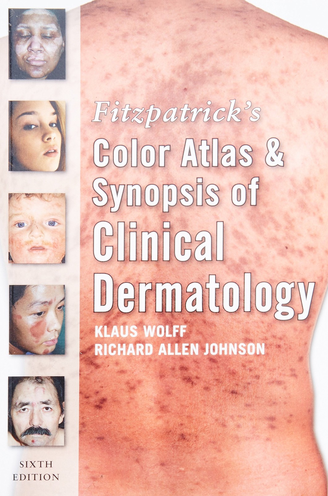 Fitzpatrick’s Color Atlas and Synopsis of Clinical Dermatology: Sixth Editio…