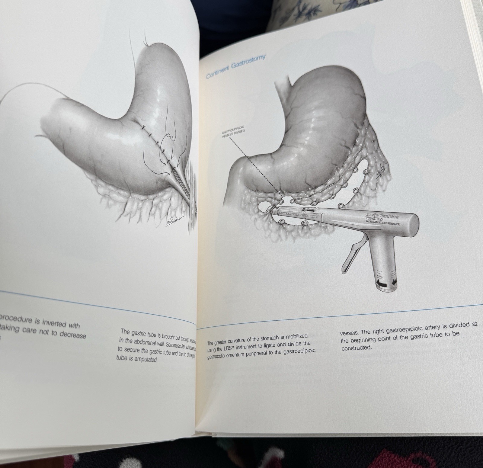 Stapling Techniques General Surgery 3rd Edition Auto Suture 1989 HC w/ Box